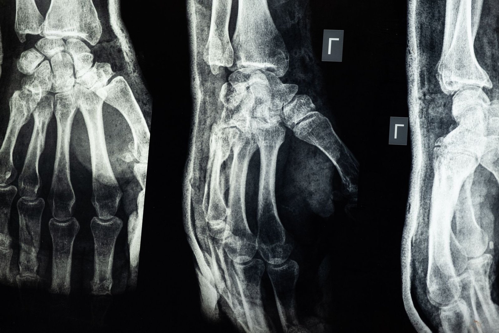 Upper limb X-ray: Wrist care photograph