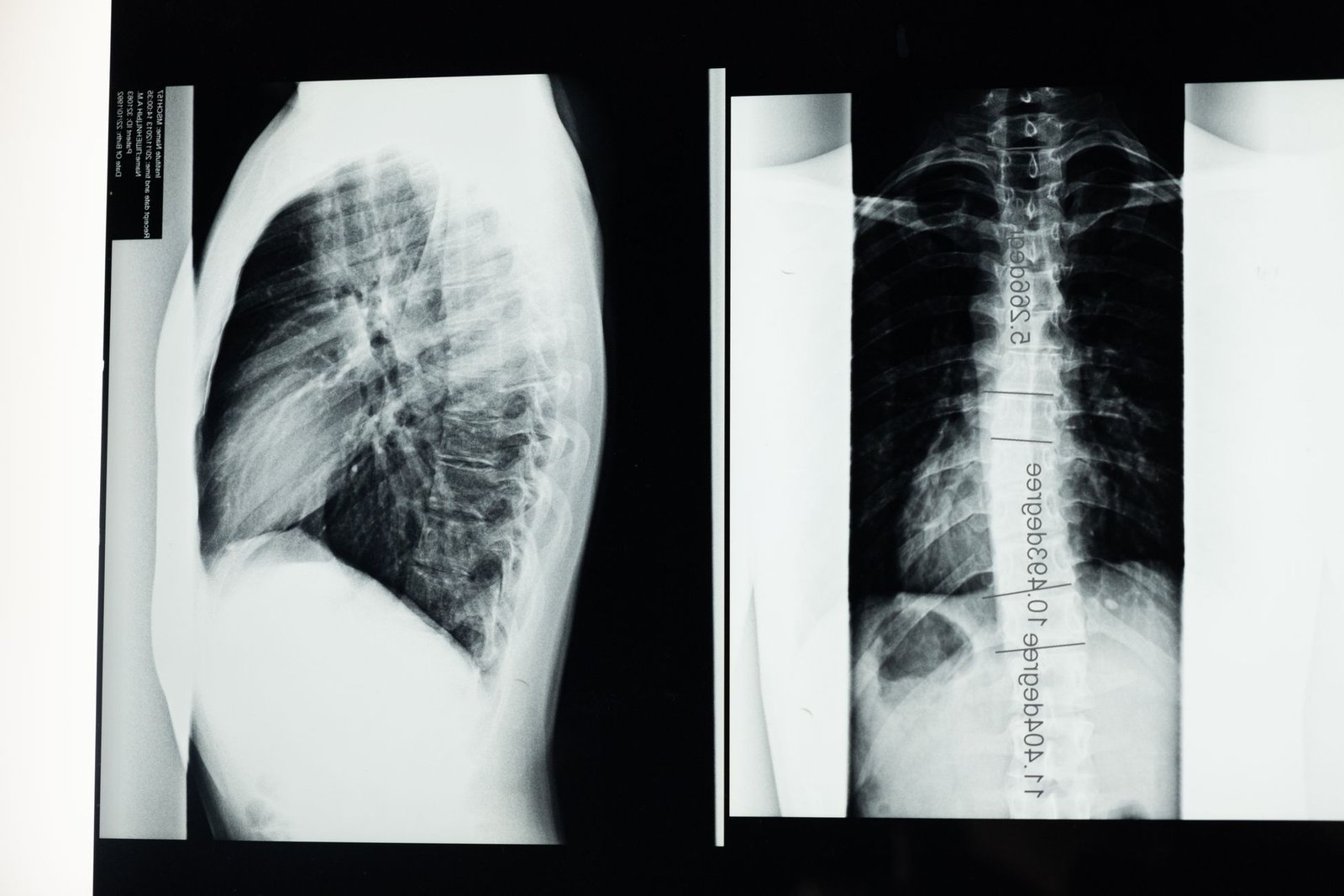 Upper limb X-ray: Clavicle care photograph