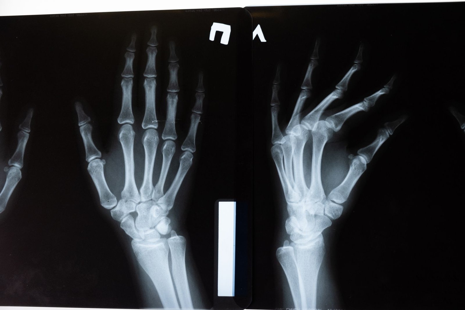 Upper limb X-ray: Hand/Finger care photograph