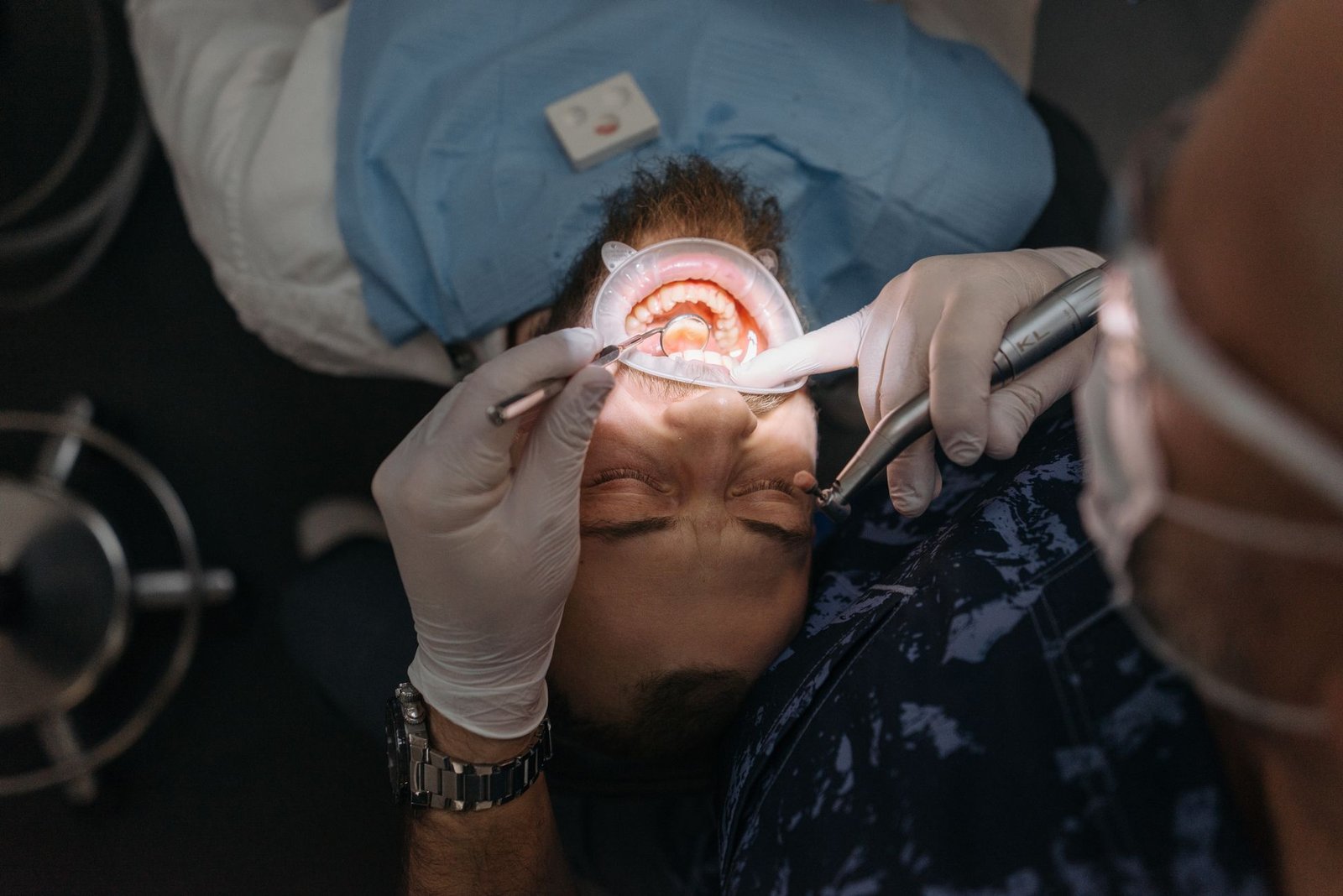 Composite Filling care photograph