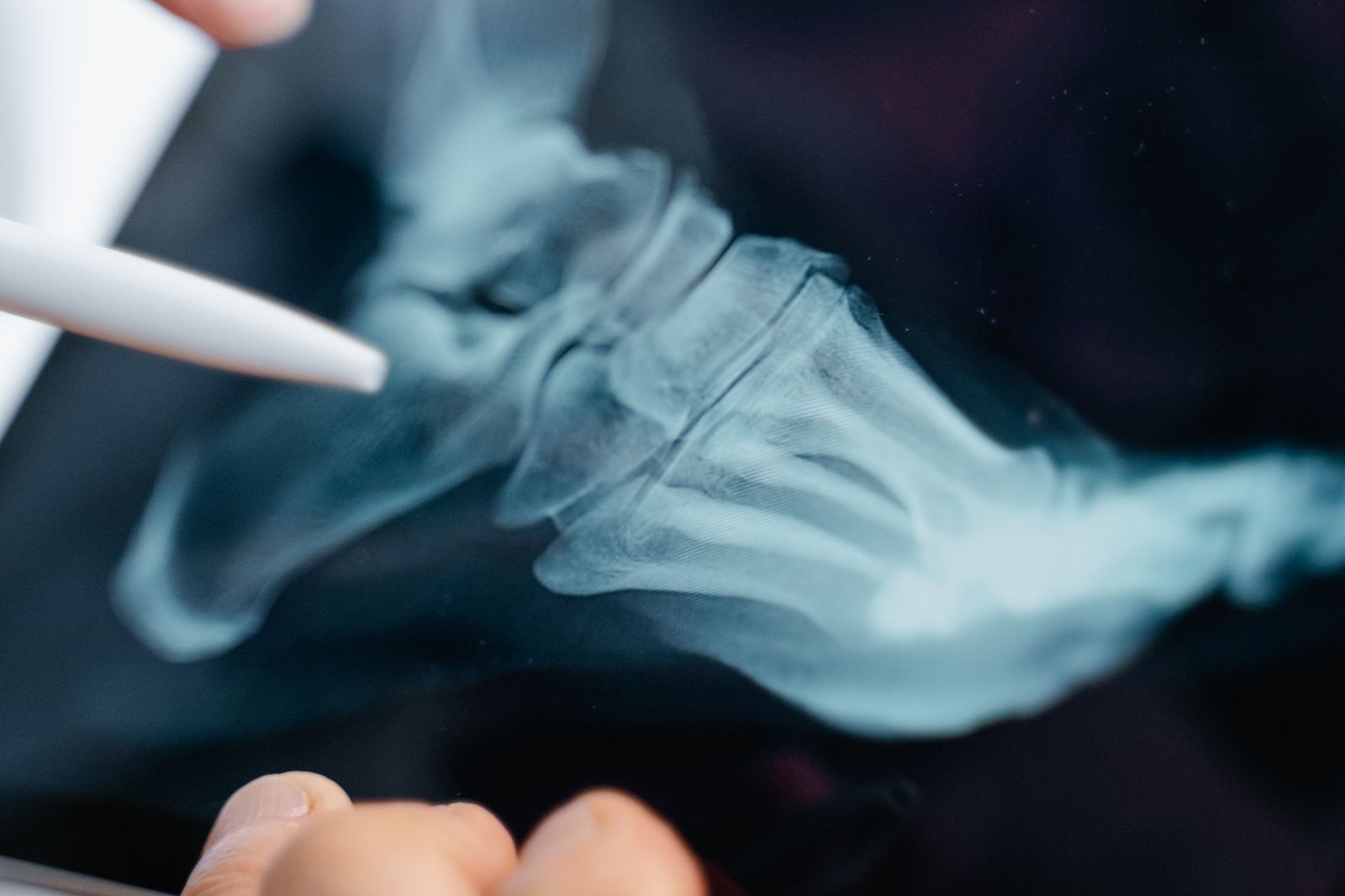 Lower limb X-ray: Foot/Toe care photograph